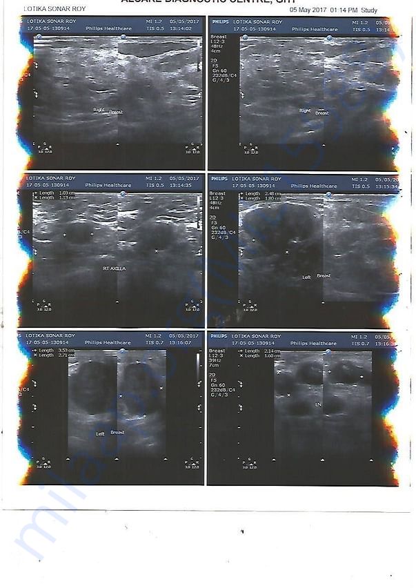 USG OF BOTH BREASTS - B