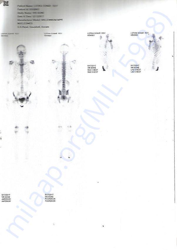 NUCLEAR BONE SCAN B