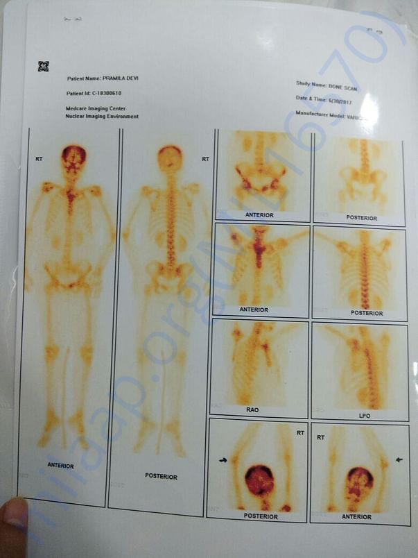 Bone Scan