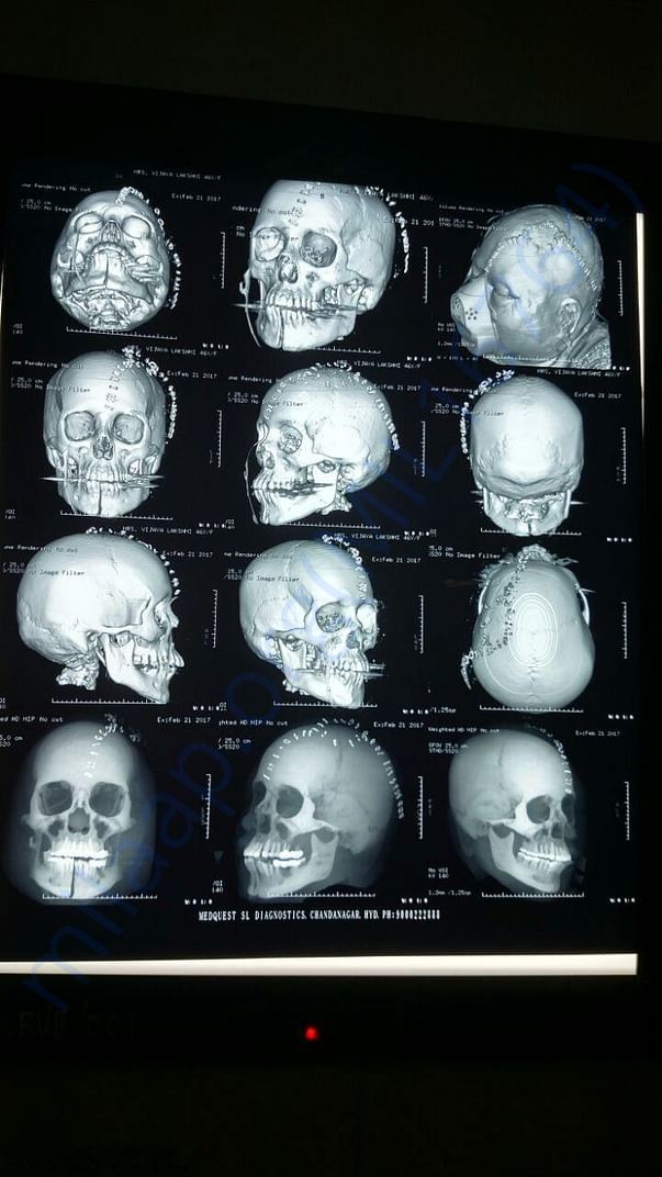 Xray