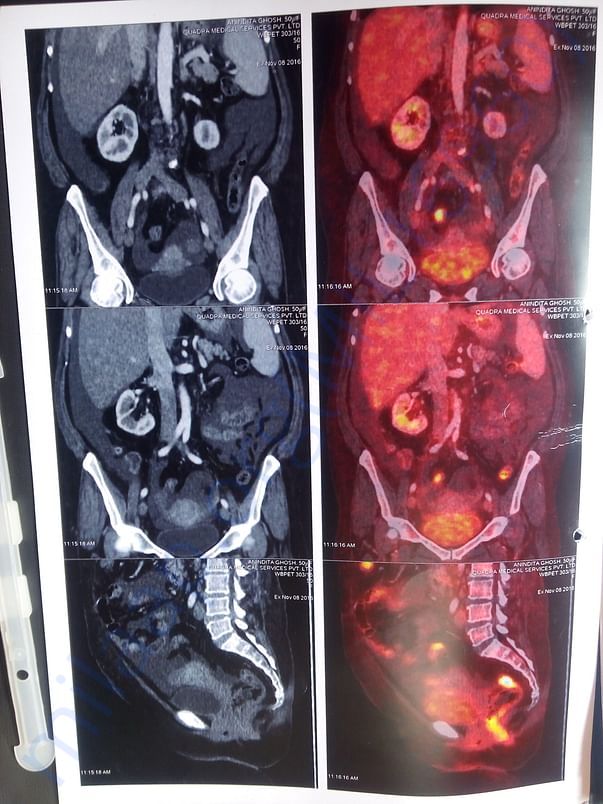 Pet scan Image 1