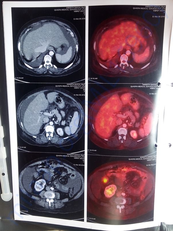 Pet scan Image2