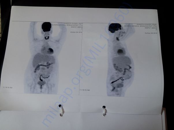 Pet scan 3