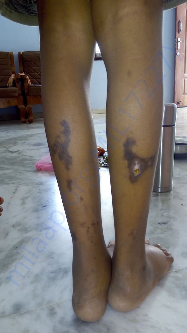 During liver and kidney treatment his bilateral leg pain treatment
