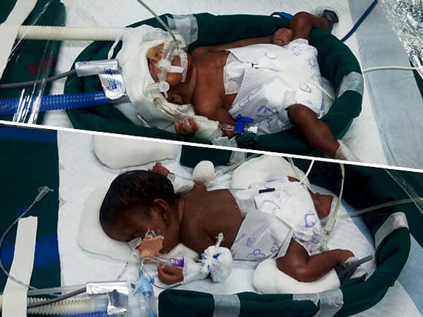 Help Premature New Born Twins To Survive