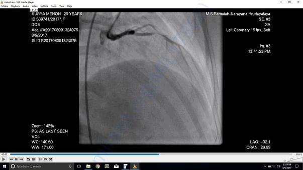 Angiogram showing the Type III vessel blockage