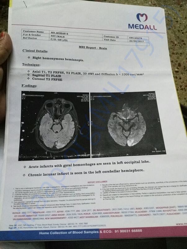 Hemianopia in brain