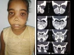 Save 11-Year-Old Girl From Fibrous Dysplasia
