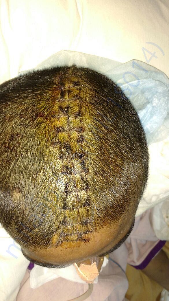 BRAIN SURGERY