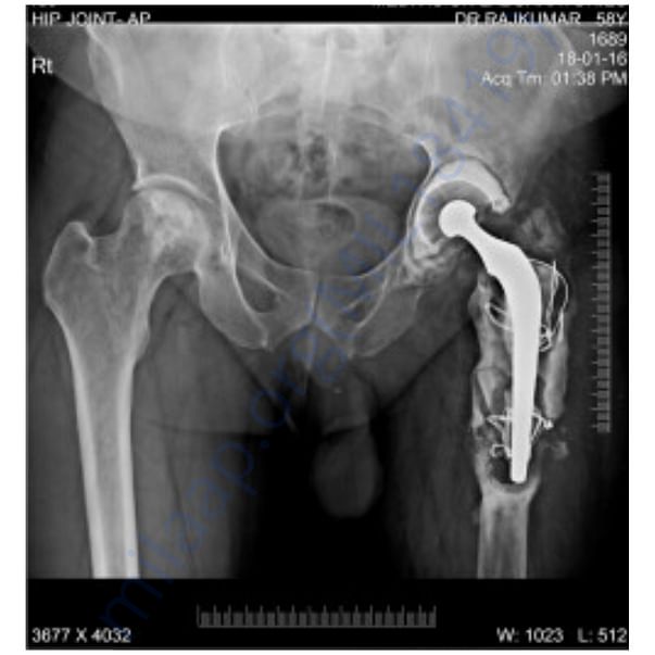 X ray left hip bone 1