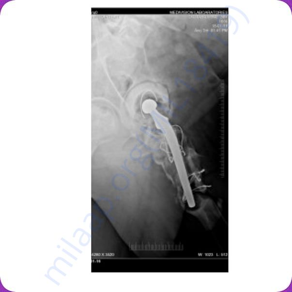 X ray left hip bone 2